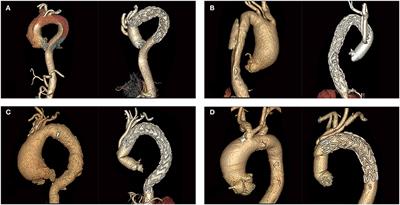 Early and Midterm Outcomes of Type II Hybrid Arch Repair for Complex Aortic Arch Pathology